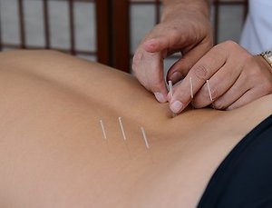 Acupuncture. Acupuncture Witney Oxfordshire needles back