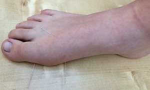 Acupuncture. acupuncture witney oxfordshire amy's foot